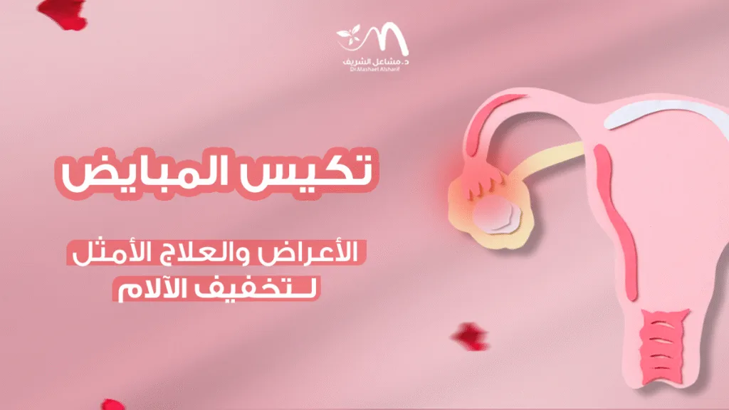 تكيس المبايض: الأعراض والعلاج الأمثل لتخفيف الآلام