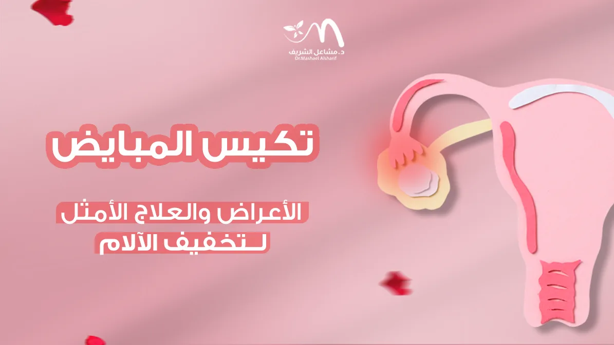 تكيس المبايض: الأعراض والعلاج الأمثل لتخفيف الآلام