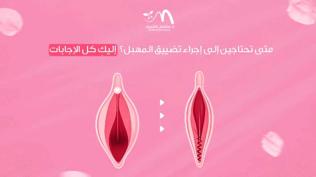 متى تحتاجين إلى إجراء تضييق المهبل؟ إليكِ كل الإجابات