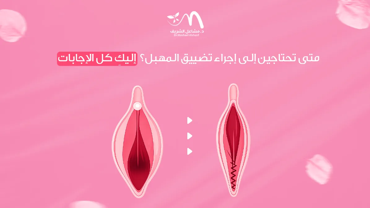 متى تحتاجين إلى إجراء تضييق المهبل؟ إليكِ كل الإجابات