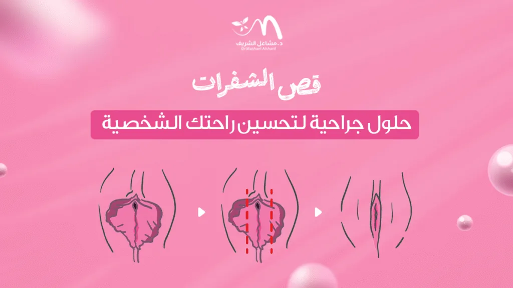 قص الشفرات: حلول جراحية لتحسين راحتك الشخصية